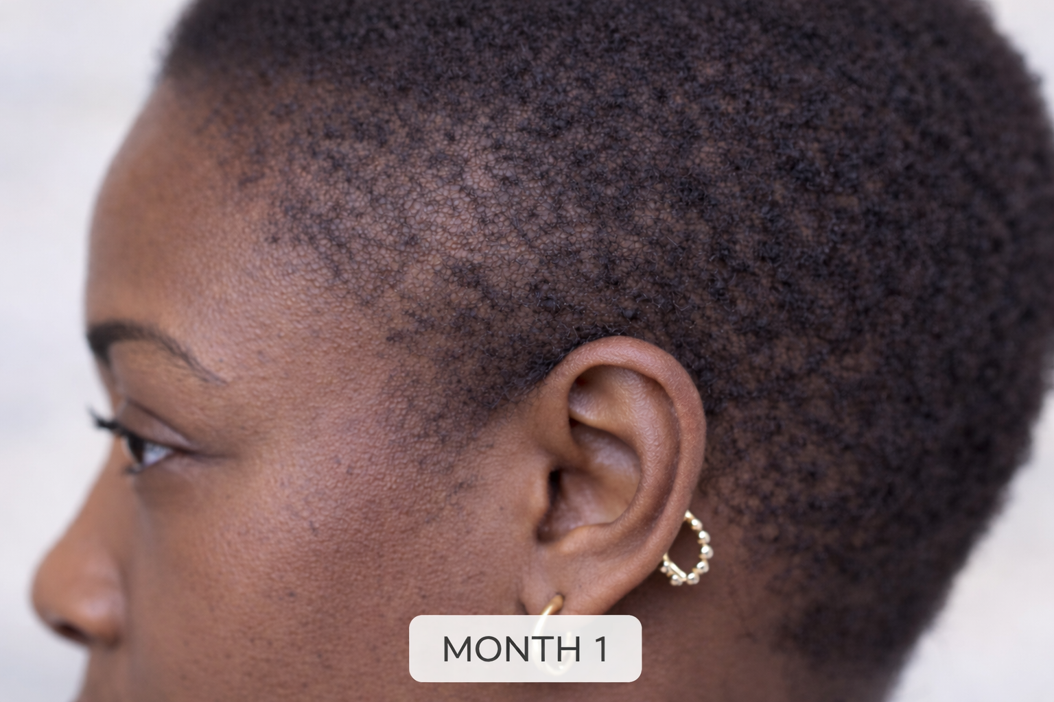 THE PEN
Multi-Complex Scalp Treatment
Powered by Strength Complex™ | 300,000 PPM