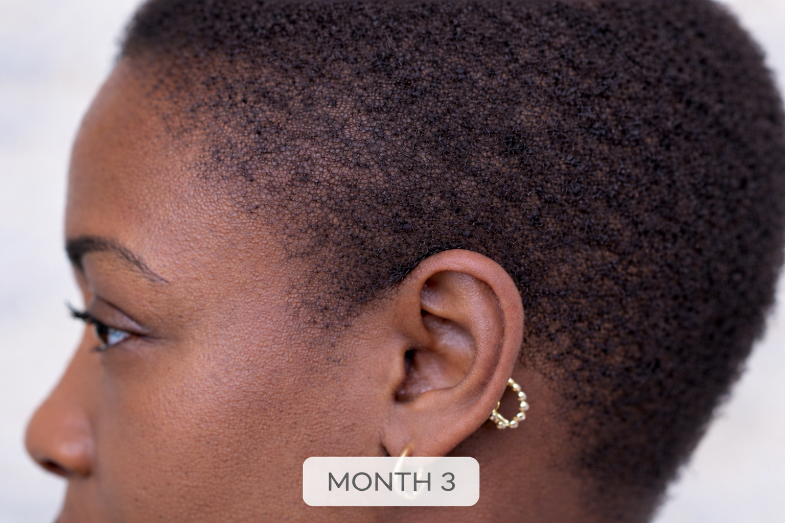 THE PEN

Multi-Complex Scalp Treatment

Powered by Strength Complex™ | 300,000 PPM